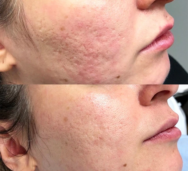 Peptide facial Dubai