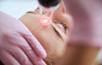 Q Switch Laser Treatment Dubai